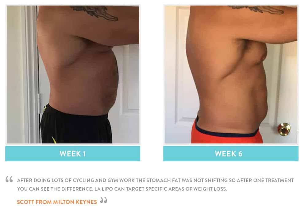 Before & After Stomach Fat Sunbury