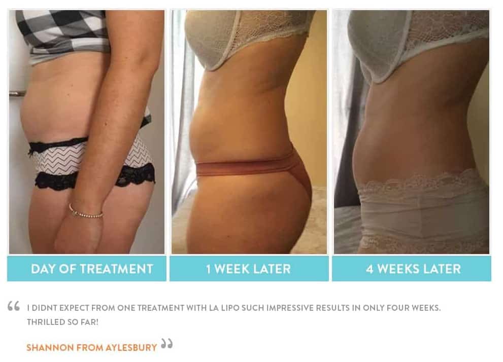 before, Cryolipolysis Sunbury