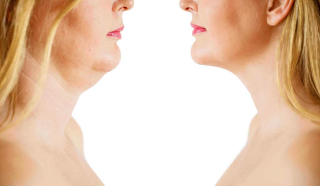 Double Chin treatment Sunbury before and after results