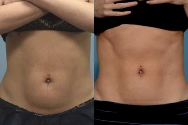 body sculpting FAQs Sunbury