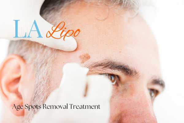 What Are the Most Effective Treatments for Age Spots Sunbury?