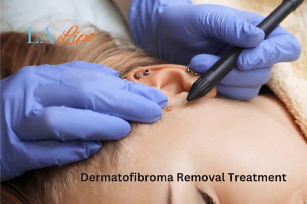 Dermatofibroma Removal Treatment Sunbury
