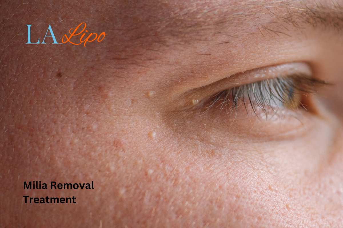 Cryopen Milia Removal: Is It the Easiest and Safest Option Sunbury?