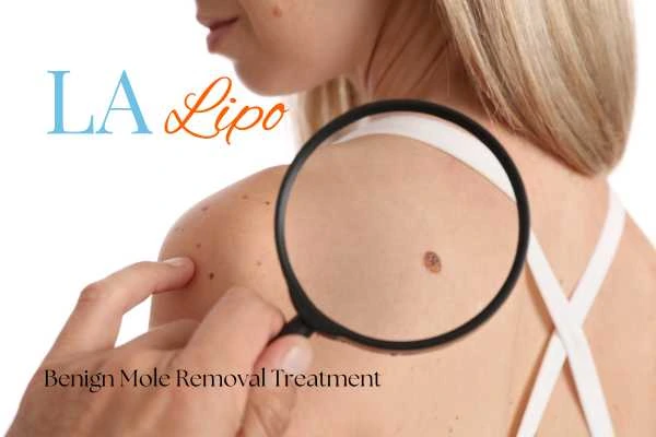 Woman having her inspection of blemish before mole removal Sunbury