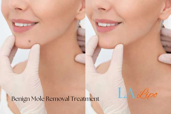 Before and after mole removal Sunbury treatment