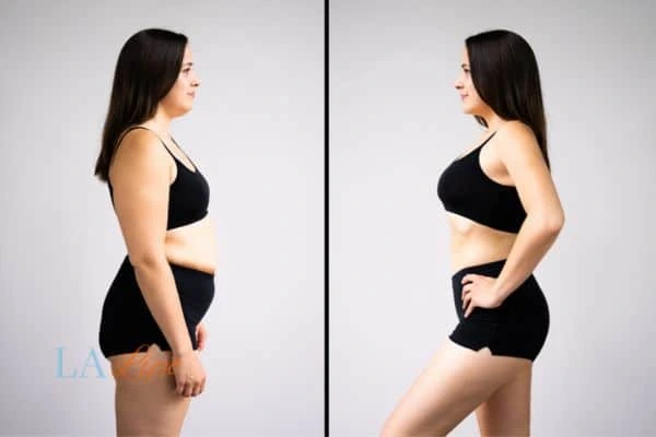 image of woman before and after results of LA-EMS Body Sculpting Sunbury to help treat Diastasis recti