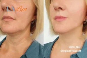 hi-fu for wrinkles Sunbury before and after results