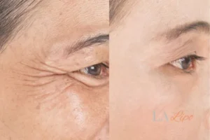 Before and after results of woman - HI-fu wrinkles reduction treatment Sunbury