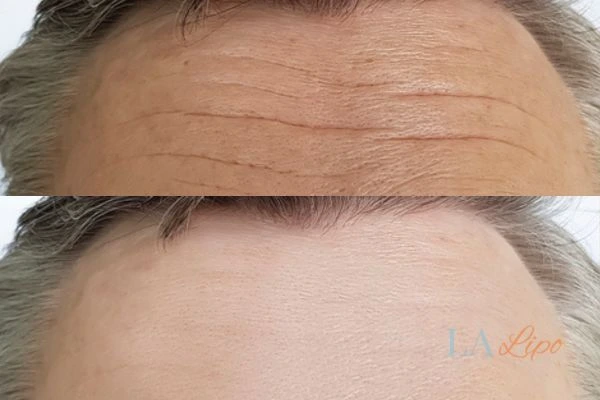 results of HIFU Sunbury on mans forehead to help reduce lines and wrinkles