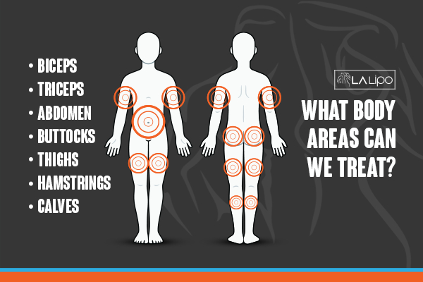 Graphic to show areas you can have LA-EMS Body Sculpting Sunbury treatment.