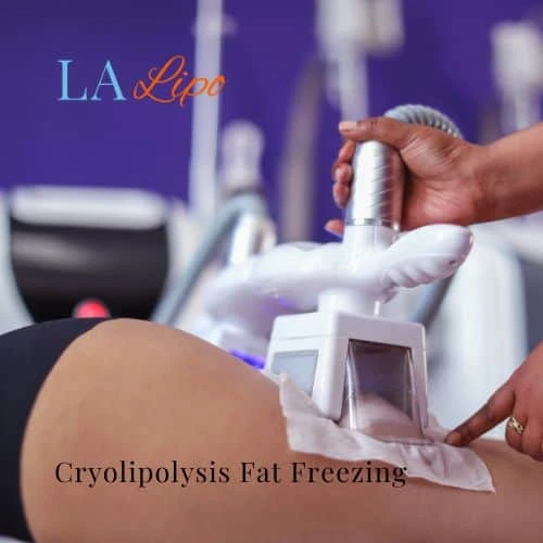 fat freezing - Cryolipolysis Sunbury