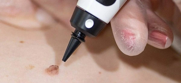 skin tag removal using cryopen Sunbury