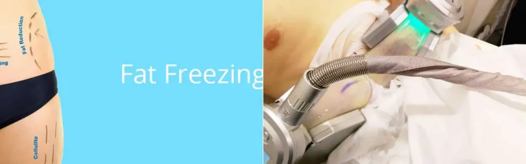 multi areas of a persons body having coolsculpting Sunbury treatment