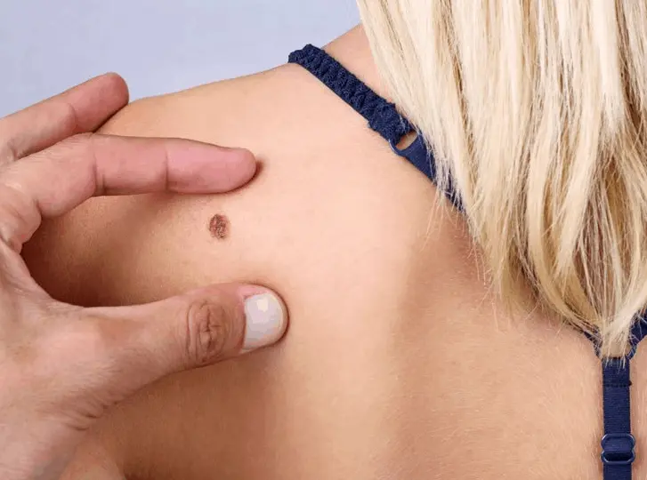 woman having mole removal Sunbury consultation before treatment.