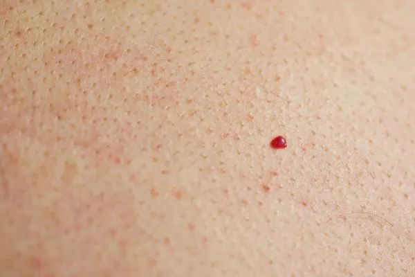 close up of a cherry angioma Sunbury