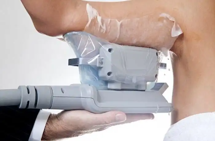 Picture of fat freezing Sunbury on the upper arms.