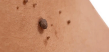 image of a skin tag Sunbury