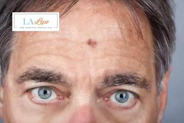 Solar Lentigo Removal Sunbury image of man with mark on his forehead