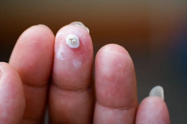 wart on person finger - cryotherapy to treat from LA LIPO Sunbury