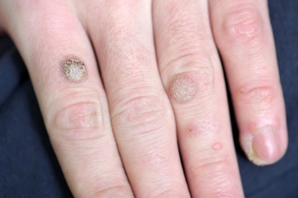 photo of warts on person hand - see wart removal Sunbury from LA LIPO
