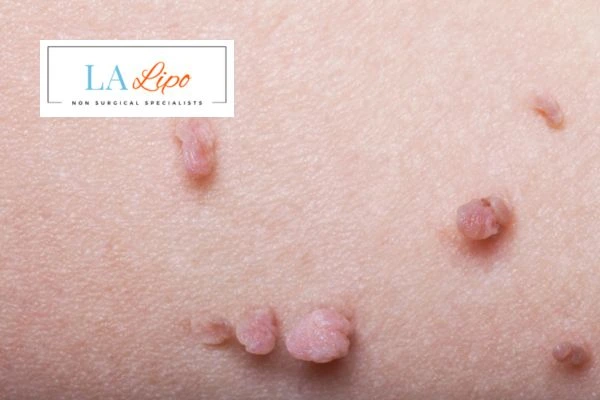 Does cryopen skin tag removal Sunbury hurt? Find out now call our team today!