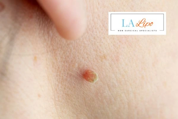 Book skin tag removal Sunbury today speak to our team now!