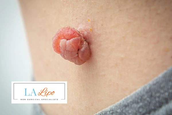 Interested in skin tag removal Sunbury? Concerned about the pain? Find out more today!