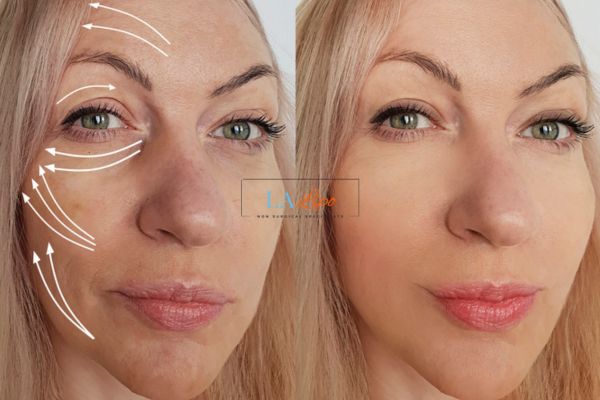 Morpheus 8 results Sunbury face lift.