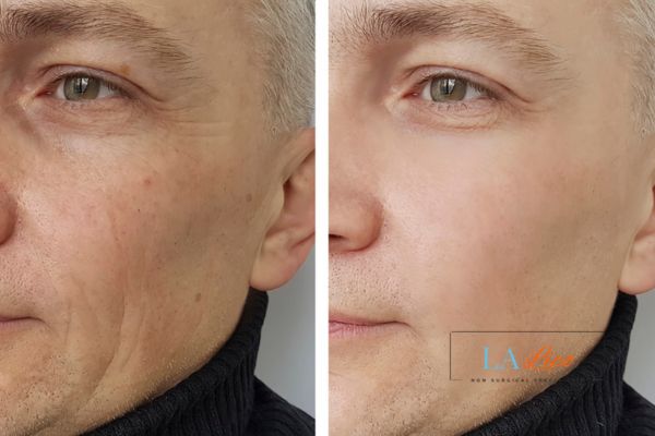 See the amazing results of Morpheus8 Treatment Sunbury!