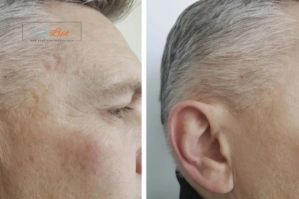 Mens Before & After Morpheus 8 Results Sunbury