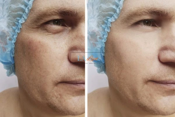 Before and after Morpheus 8 Results Sunbury