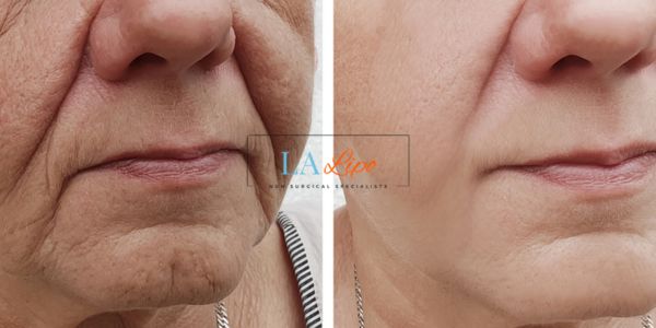 Older lady deeper wrinkle reduction - LA LIPO Morpheus 8 Results Sunbury