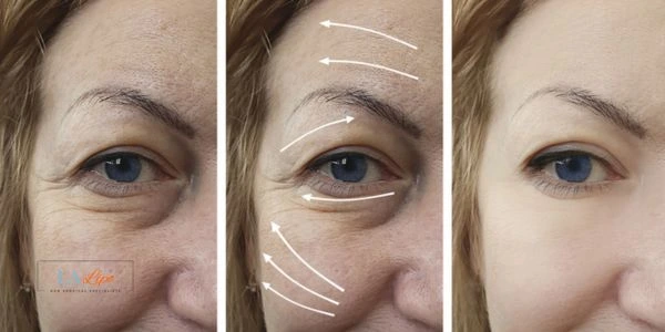 Amazing eye lift Morpheus 8 results Sunbury