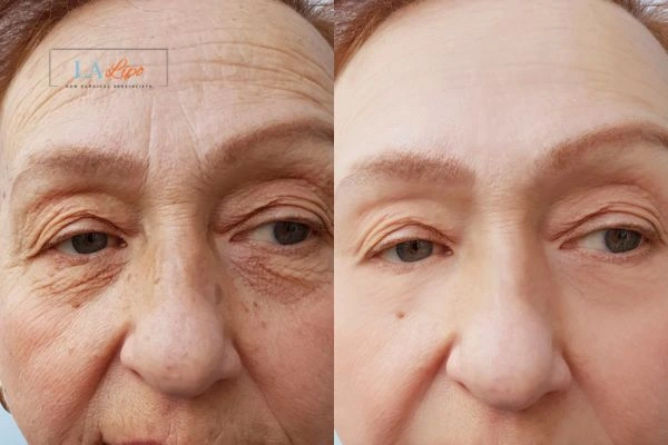 The powerful benefits of Morpheus8 Treatment Sunbury - Call Our team today!