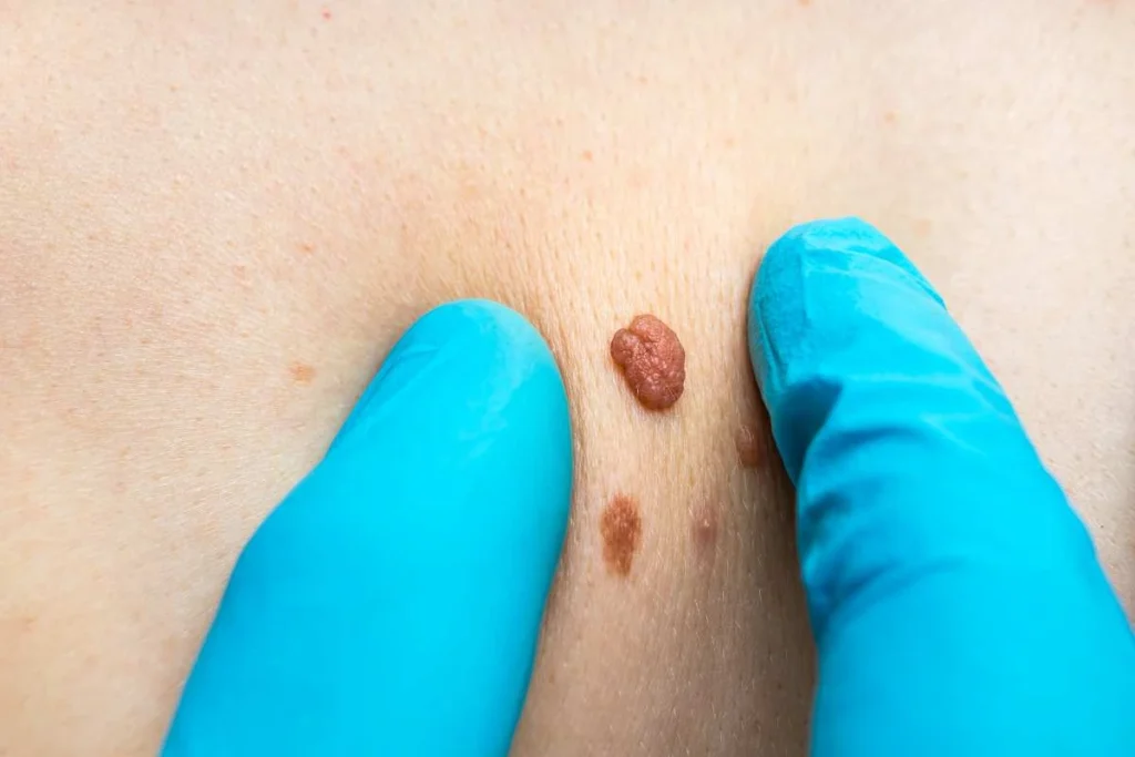 LA LIPO Cryopen Lesion Removal Prices Sunbury