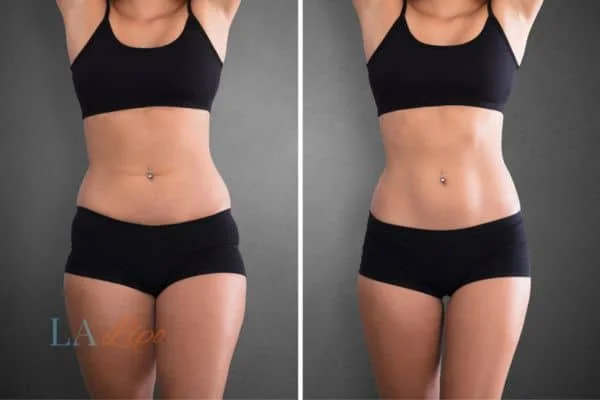 before and after results of non-surgical treatment to help a woman's body image and mental health Sunbury