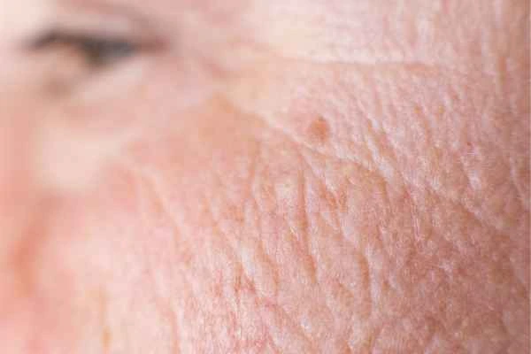 close up picture of a woman's face showing an age spot Sunbury