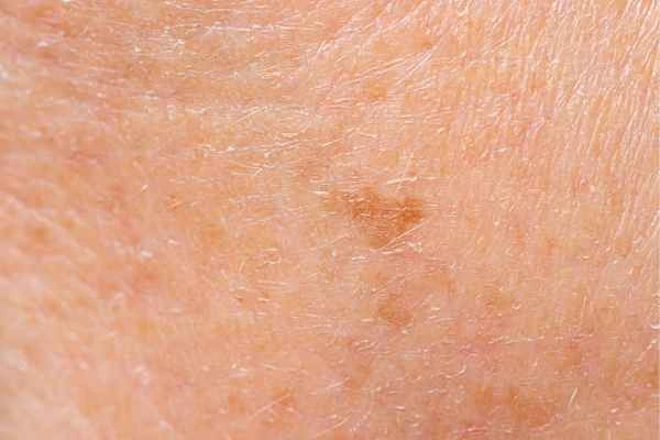 close up picture of age spots Sunbury