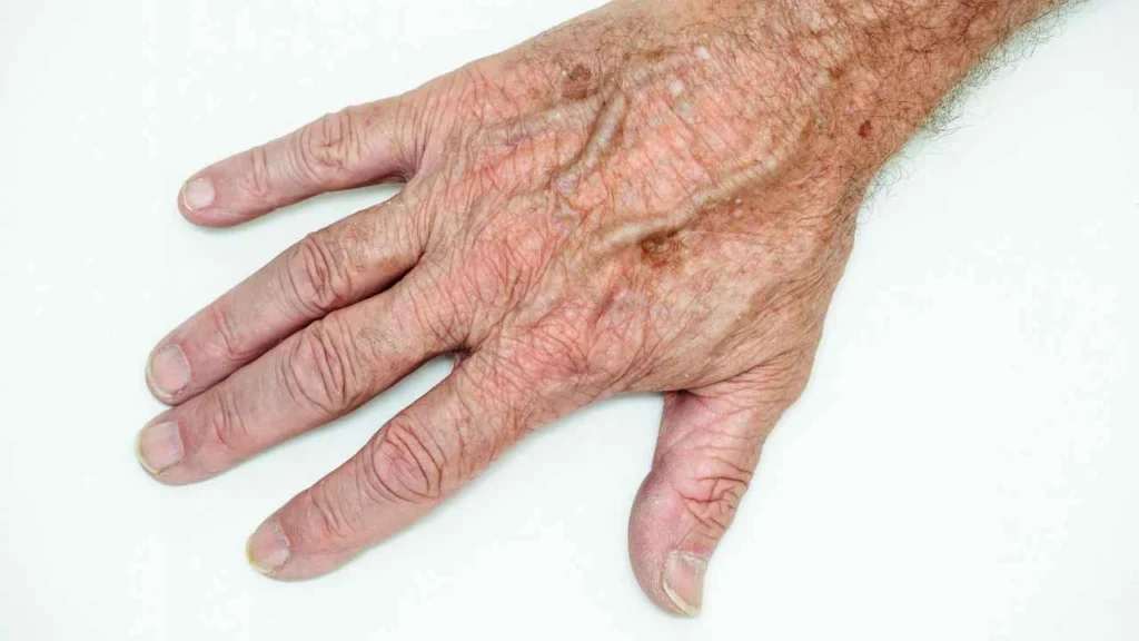 Male hand showing age spot Sunbury
