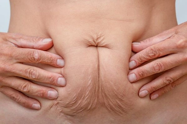 Image of a woman's stomach with loose skin - example of skin tightening Sunbury options