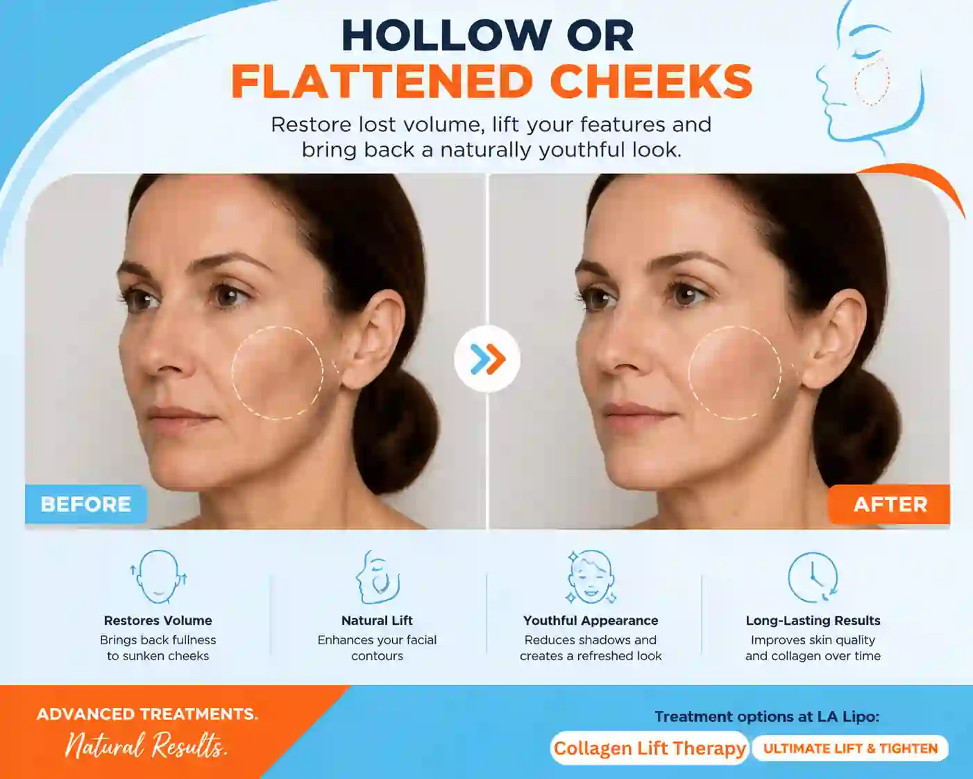 Sign #4: Hollow or Flattened Cheeks Sunbury