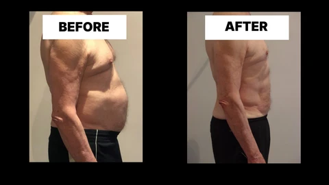 What Symptoms Can Diastasis Recti Cause in Men? Weak Core, Back Pain and Poor Posture Sunbury